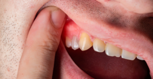 Abscessed Tooth - Emergency Dental of Sacramento