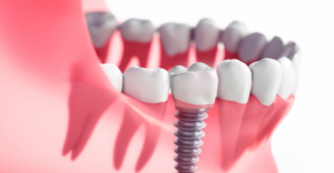 Implants - Emergency Dental of Sacramento