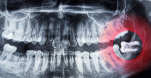 wisdom teeth - Emergency Dental of Sacramento